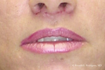 Lip Lift after 635441