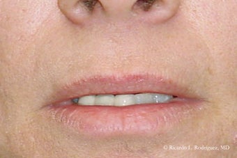 Lip Lift before 635441