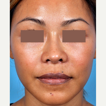 35-44 year old woman treated with Rhinoplasty after 3815652