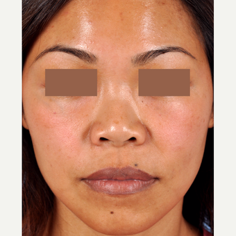 35-44 year old woman treated with Rhinoplasty before 3815652