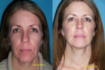 Laser resurfacing with filler and skin care before 1058133