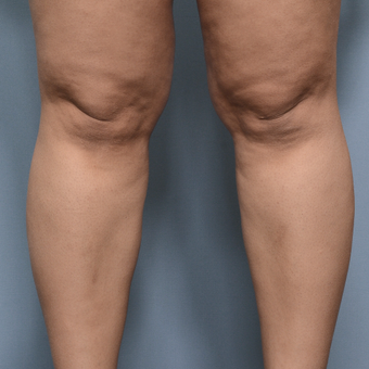 25-34 year old woman treated with Liposuction before 3234418