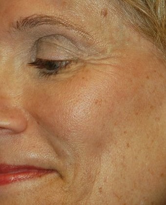 Dysport - The BOTOX Alternative before 136235