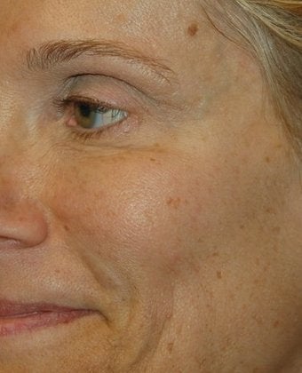 Dysport - The BOTOX Alternative after 136235