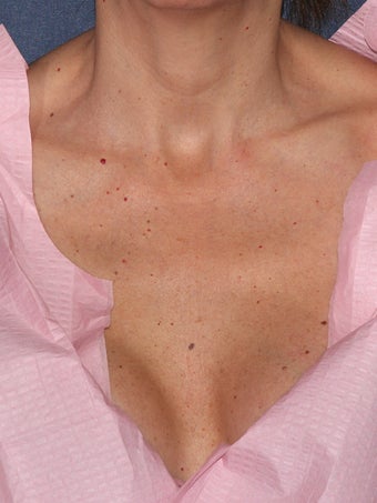 40 year female with cherry angiomas on chest before 1060823