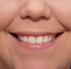 25-34 year old woman treated with Botox after 3007537