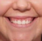25-34 year old woman treated with Botox before 3007537