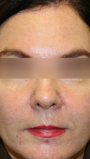 Botox and Restylane after 994190