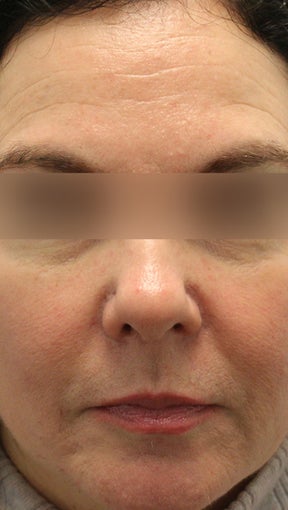 Botox and Restylane before 994190