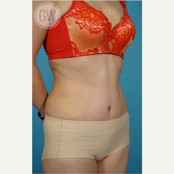 35-44 year old woman treated with Tummy Tuck after 3016683