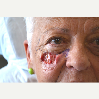 65-74 year old woman treated with Facial Reconstructive Surgery before 3741614