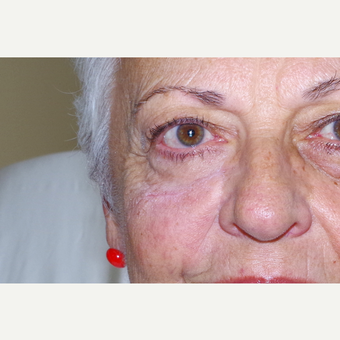 65-74 year old woman treated with Facial Reconstructive Surgery after 3741614