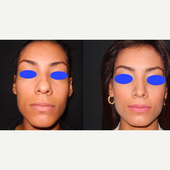 25-34 year old woman treated with Rhinoplasty before 3390093