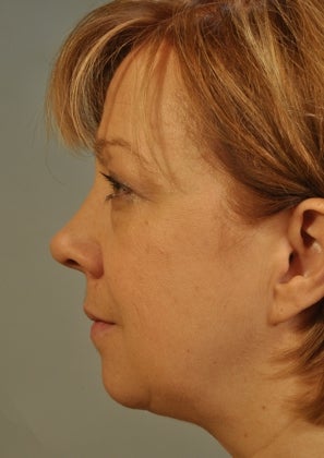 Lower lid Hetter Peel along with upper and lower eyelid surgery. 857701