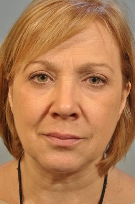 Lower lid Hetter Peel along with upper and lower eyelid surgery. after 857701