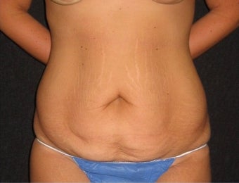 25-34 year old woman treated with Tummy Tuck before 3043462