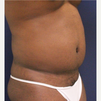 25-34 year old man treated with Smart Lipo after 3237063
