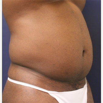 25-34 year old man treated with Smart Lipo before 3237063