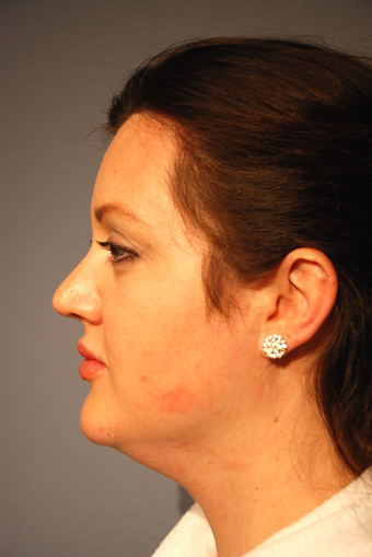 25-34 year old woman treated with Kybella before 2786826