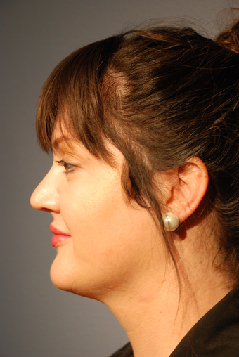 25-34 year old woman treated with Kybella after 2786826