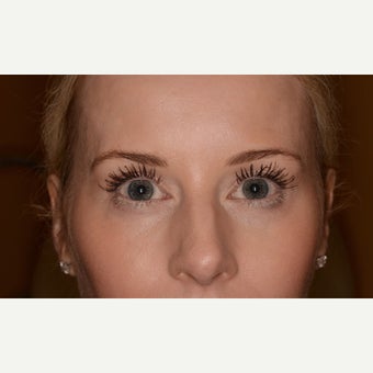 Temple rejuvenation with Voluma after 1540861