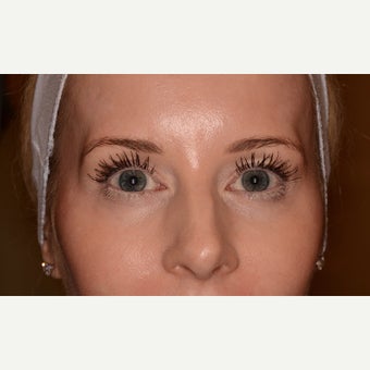 Temple rejuvenation with Voluma before 1540861
