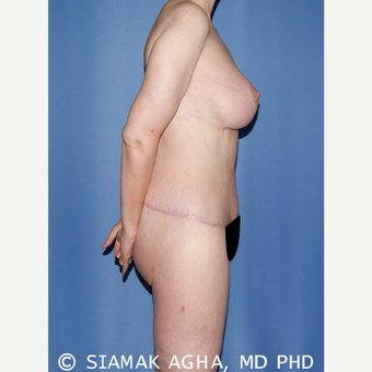 45-54 year old woman treated with Body Lift after 3629113
