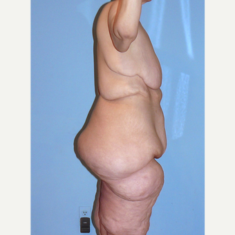 45-54 year old woman treated with Body Lift before 3629113