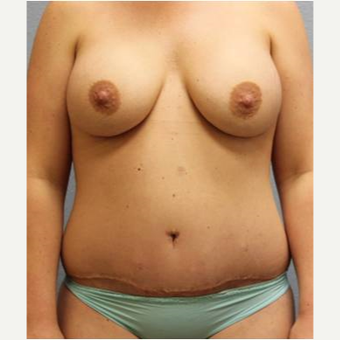 25-34 year old woman treated with Mommy Makeover after 3423943