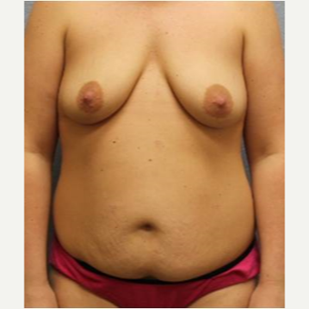 25-34 year old woman treated with Mommy Makeover before 3423943