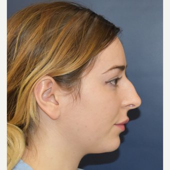 18-24 year old woman treated with Rhinoplasty before 3503427