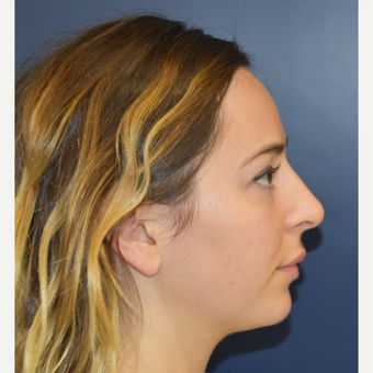 18-24 year old woman treated with Rhinoplasty after 3503427