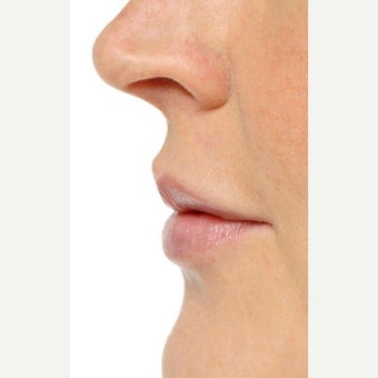 35-44 year old woman treated with Lip Augmentation after 1707951