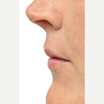 35-44 year old woman treated with Lip Augmentation before 1707951