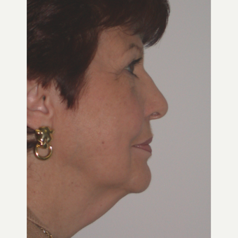 65-74 year old woman treated with Facelift before 3261767