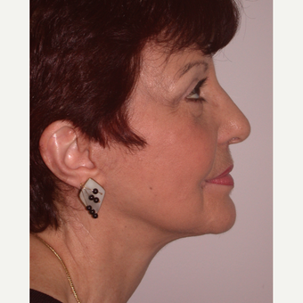 65-74 year old woman treated with Facelift after 3261767