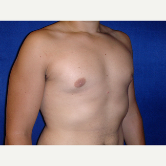 25-34 year old man treated with Male Breast Reduction after 3727313