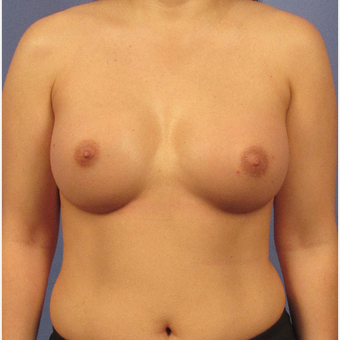 25-34 year old woman treated with Breast Augmentation after 3106692