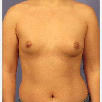 25-34 year old woman treated with Breast Augmentation before 3106692