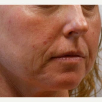 Filler treatment for under eye and facial rejuvenation in 44 year old patient. 1940595