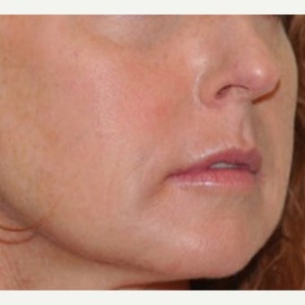 Filler treatment for under eye and facial rejuvenation in 44 year old patient. 1940595