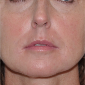 Filler treatment for under eye and facial rejuvenation in 44 year old patient. after 1940595