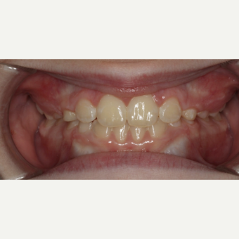 17 or under year old woman treated with Braces after 3188515