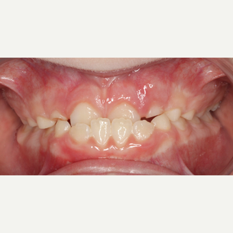 17 or under year old woman treated with Braces before 3188515