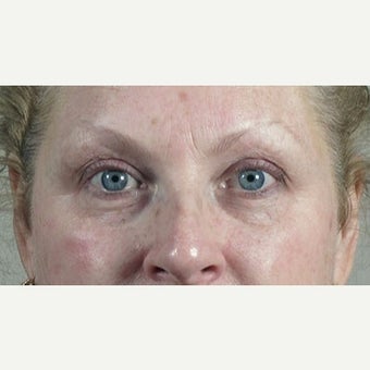 35-44 year old woman treated with Halo Laser before 1846477
