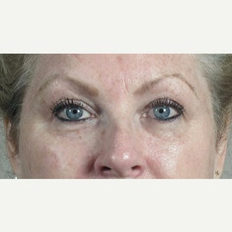 35-44 year old woman treated with Halo Laser after 1846477