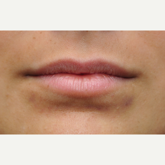 Technique to roll lips outward before 3097325