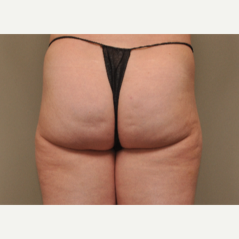 35-44 year old woman treated with Cellfina before 3453589