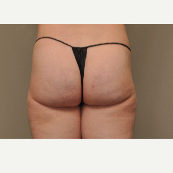 35-44 year old woman treated with Cellfina after 3453589