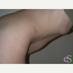 41 year old woman treated with Tummy Tuck before 3484829